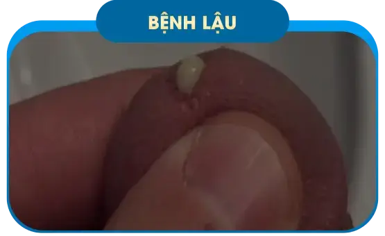 Bệnh lậu